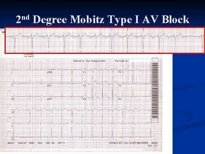 2 nd Degree Mobitz Type I AV Block 