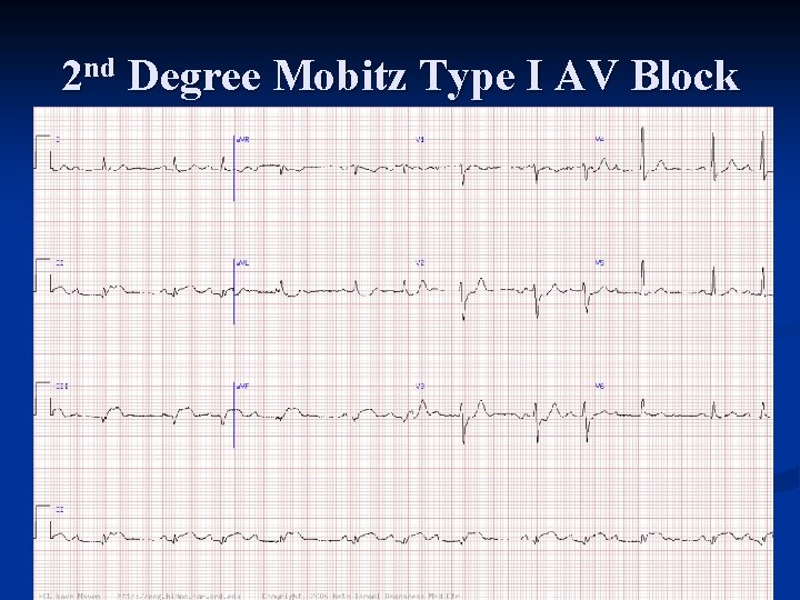 2 nd Degree Mobitz Type I AV Block 