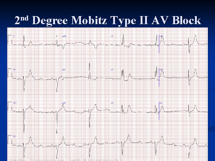 2 nd Degree Mobitz Type II AV Block 