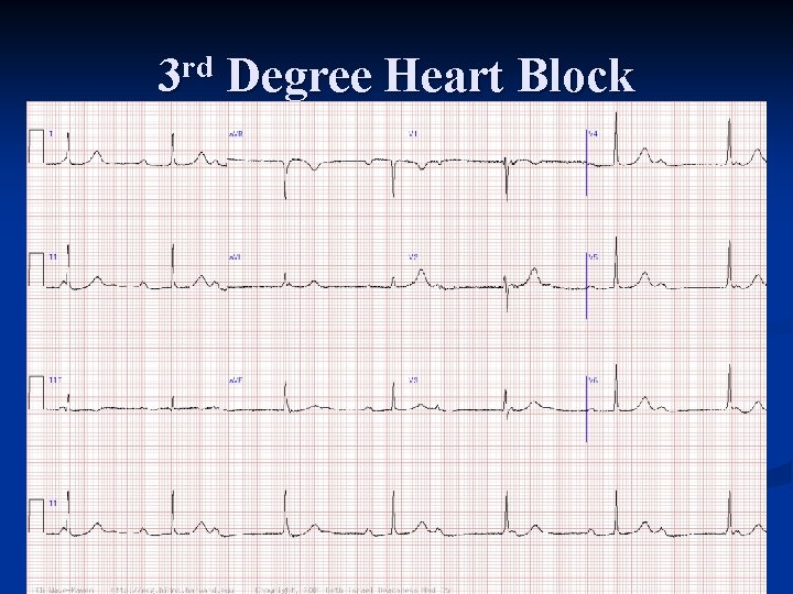 3 rd Degree Heart Block 