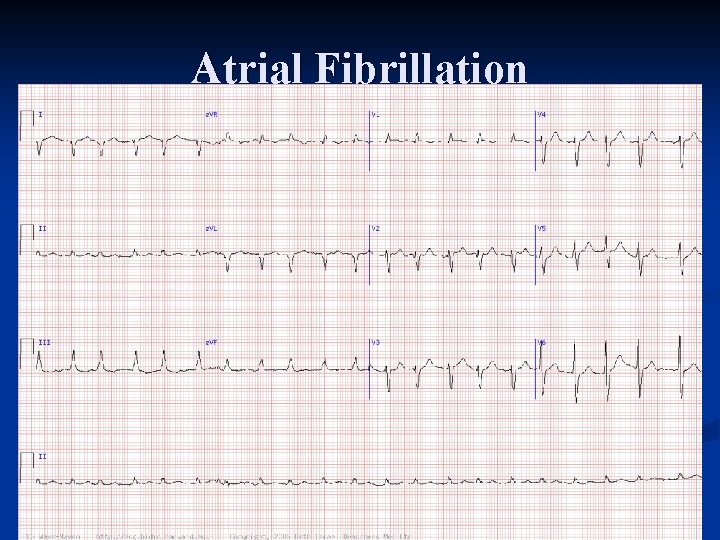 Atrial Fibrillation 