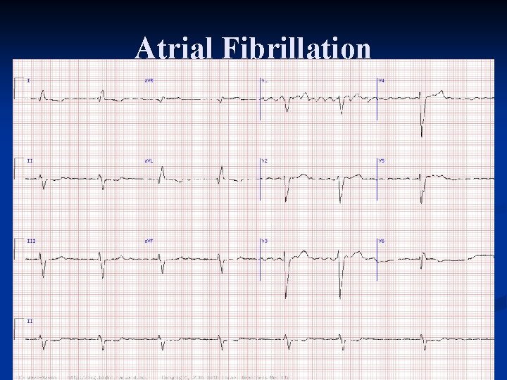 Atrial Fibrillation 