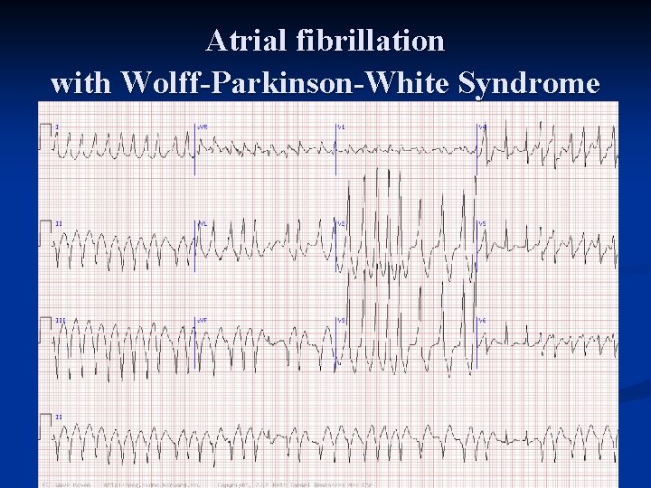 Atrial fibrillation with Wolff-Parkinson-White Syndrome 