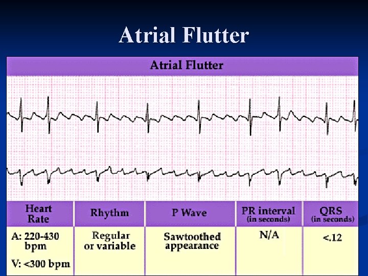 Atrial Flutter 