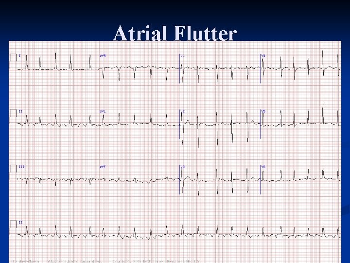 Atrial Flutter 