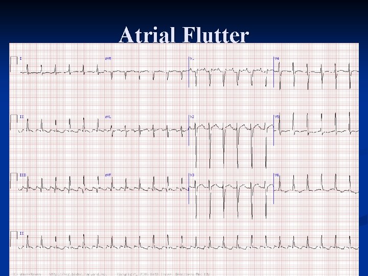 Atrial Flutter 