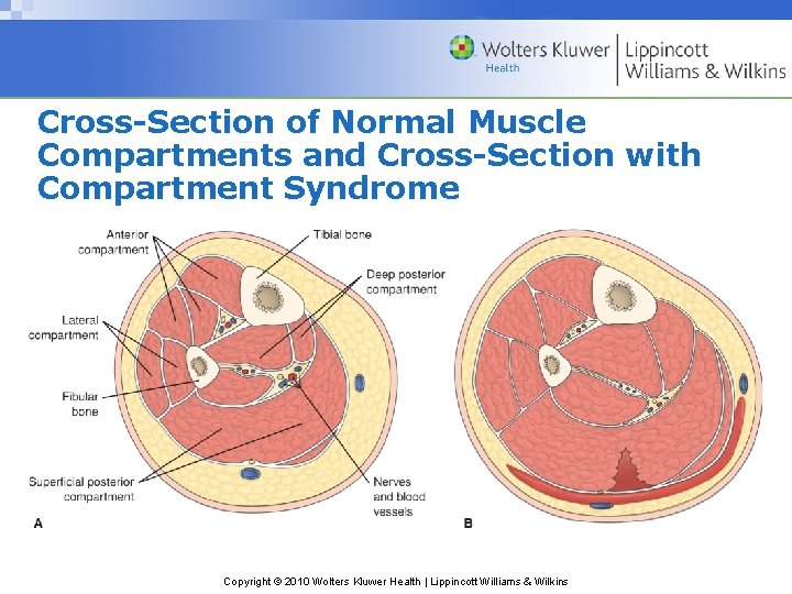 Cross-Section of Normal Muscle Compartments and Cross-Section with Compartment Syndrome Copyright © 2010 Wolters