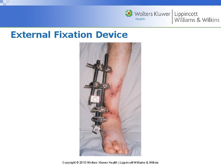 External Fixation Device Copyright © 2010 Wolters Kluwer Health | Lippincott Williams & Wilkins