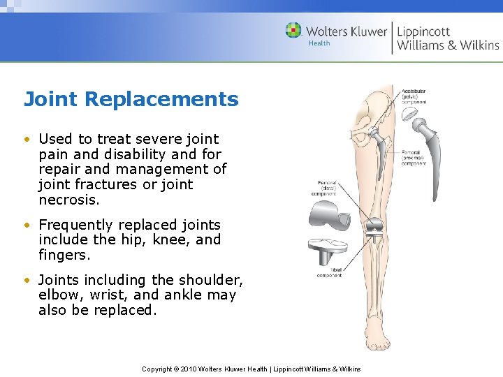 Joint Replacements • Used to treat severe joint pain and disability and for repair