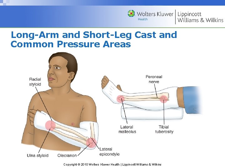 Long-Arm and Short-Leg Cast and Common Pressure Areas Copyright © 2010 Wolters Kluwer Health