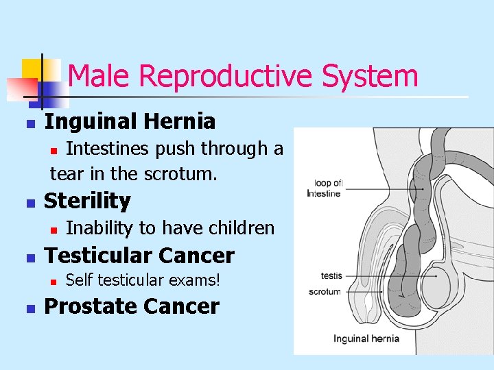 Male Reproductive System n Inguinal Hernia Intestines push through a tear in the scrotum.