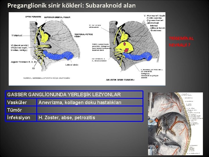 Preganglionik sinir kökleri: Subaraknoid alan TRİGEMİNAL NEVRALJİ ? GASSER GANGLİONUNDA YERLEŞİK LEZYONLAR Vasküler Anevrizma,