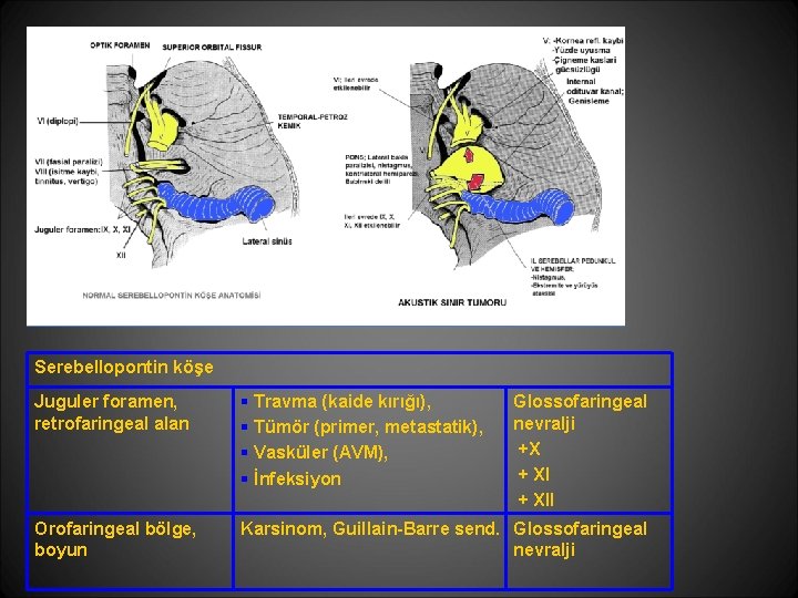 Serebellopontin köşe Juguler foramen, retrofaringeal alan § Travma (kaide kırığı), § Tümör (primer, metastatik), Serebellopontin köşe Juguler foramen, retrofaringeal alan § Travma (kaide kırığı), § Tümör (primer, metastatik),