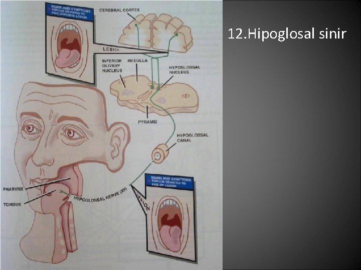 12. Hipoglosal sinir 