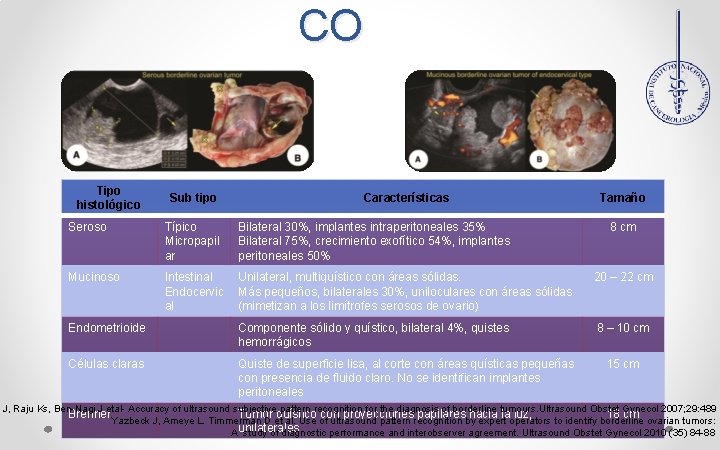 CO Tipo histológico Sub tipo Características Tamaño Seroso Típico Micropapil ar Bilateral 30%, implantes