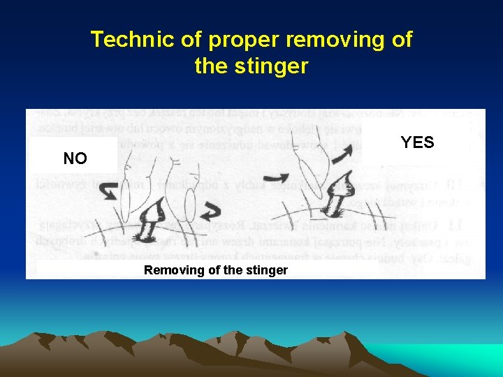 Technic of proper removing of the stinger YES NO Removing of the stinger Technic of proper removing of the stinger YES NO Removing of the stinger