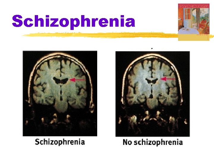 Schizophrenia 