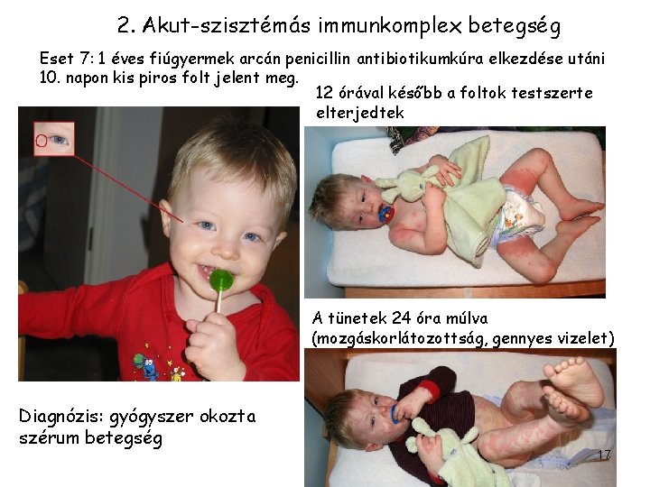 2. Akut-szisztémás immunkomplex betegség Eset 7: 1 éves fiúgyermek arcán penicillin antibiotikumkúra elkezdése utáni