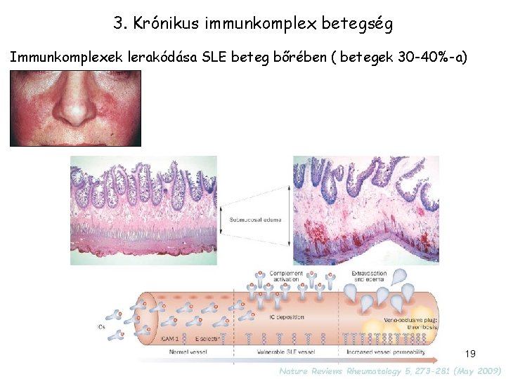 3. Krónikus immunkomplex betegség Immunkomplexek lerakódása SLE beteg bőrében ( betegek 30 -40%-a) 19