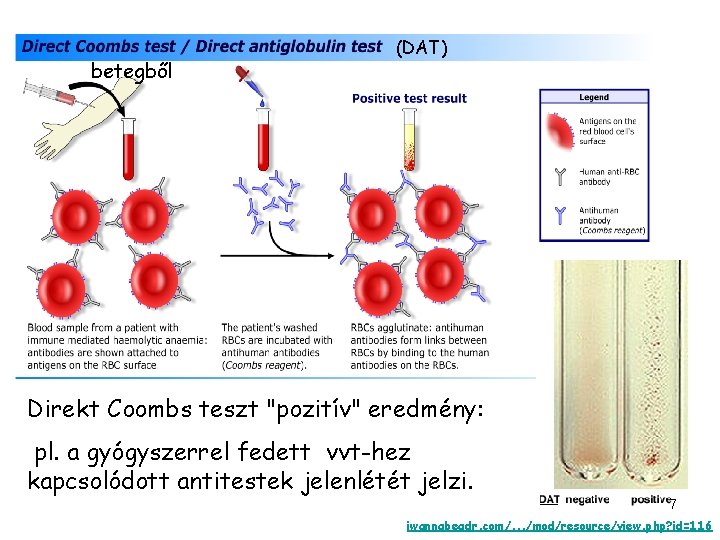 betegből (DAT) Direkt Coombs teszt "pozitív" eredmény: pl. a gyógyszerrel fedett vvt-hez kapcsolódott antitestek