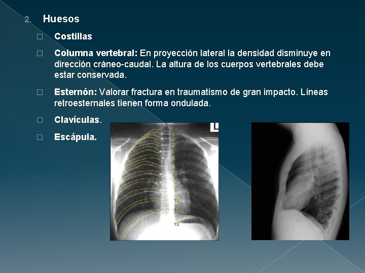 2. Huesos � Costillas � Columna vertebral: En proyección lateral la densidad disminuye en