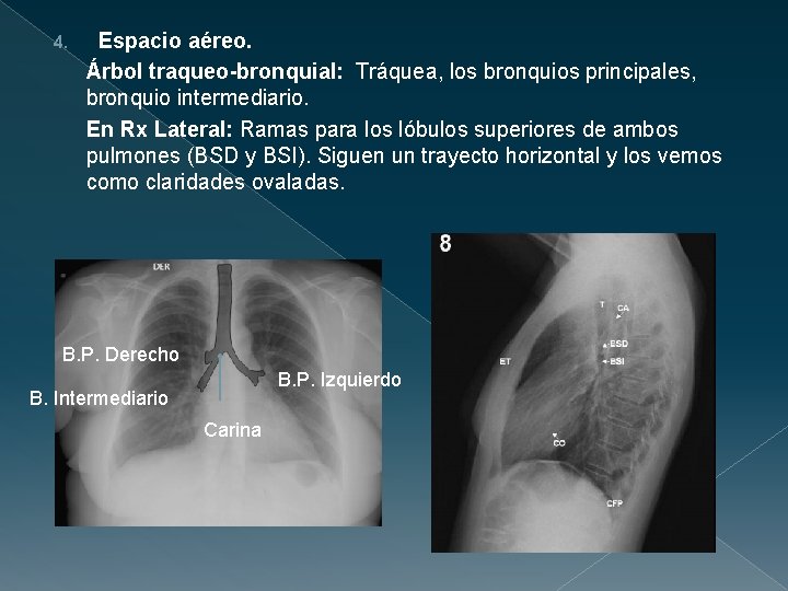 4. Espacio aéreo. Árbol traqueo-bronquial: Tráquea, los bronquios principales, bronquio intermediario. En Rx Lateral: