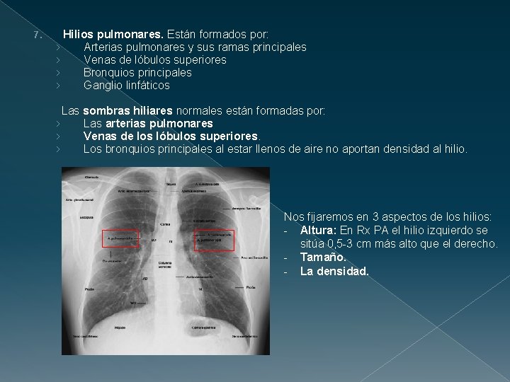 7. Hilios pulmonares. Están formados por: › Arterias pulmonares y sus ramas principales ›