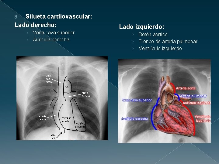 Silueta cardiovascular: Lado derecho: 8. › Vena cava superior › Auricula derecha. Lado izquierdo:
