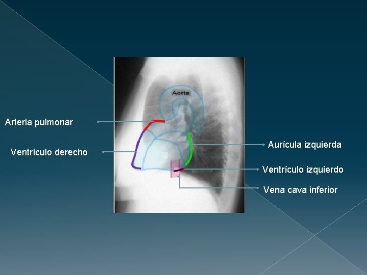 Arteria pulmonar Ventrículo derecho Aurícula izquierda Ventrículo izquierdo Vena cava inferior 