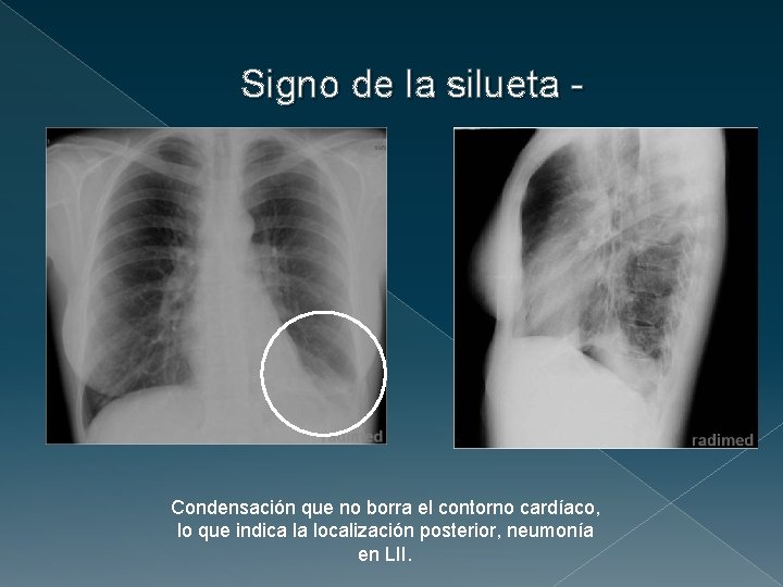 Signo de la silueta - Condensación que no borra el contorno cardíaco, lo que