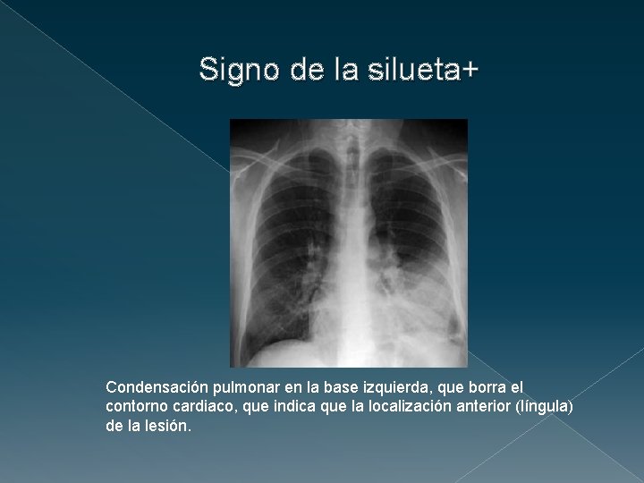 Signo de la silueta+ Condensación pulmonar en la base izquierda, que borra el contorno