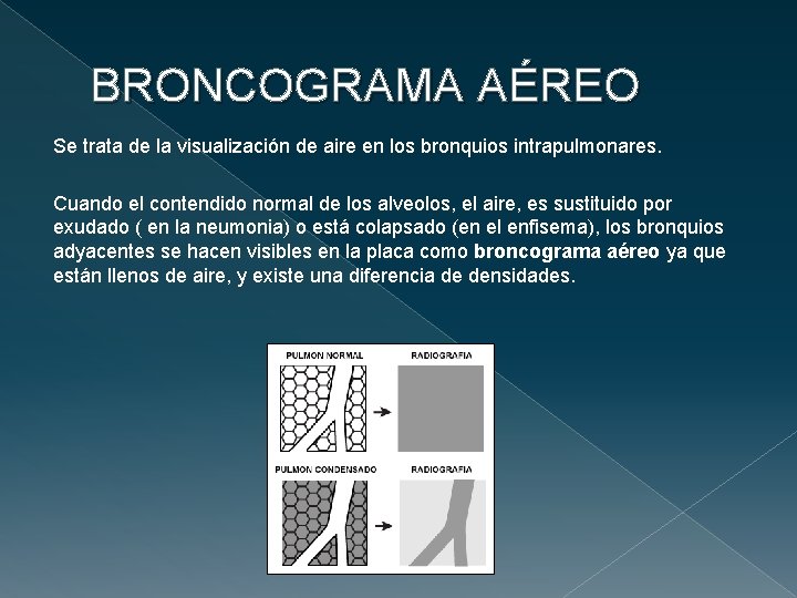 BRONCOGRAMA AÉREO Se trata de la visualización de aire en los bronquios intrapulmonares. Cuando