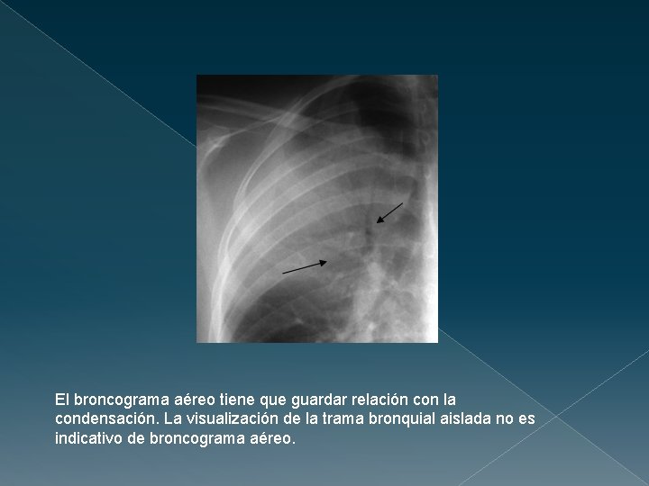 El broncograma aéreo tiene que guardar relación con la condensación. La visualización de la