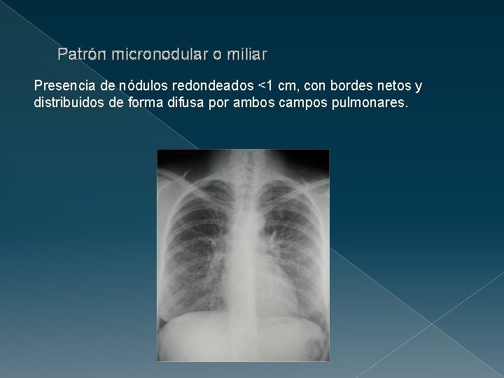 Patrón micronodular o miliar Presencia de nódulos redondeados <1 cm, con bordes netos y