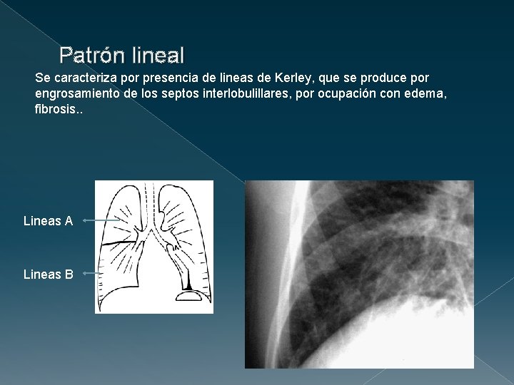 Patrón lineal Se caracteriza por presencia de lineas de Kerley, que se produce por