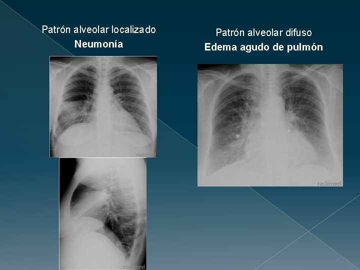 Patrón alveolar localizado Neumonía Patrón alveolar difuso Edema agudo de pulmón 
