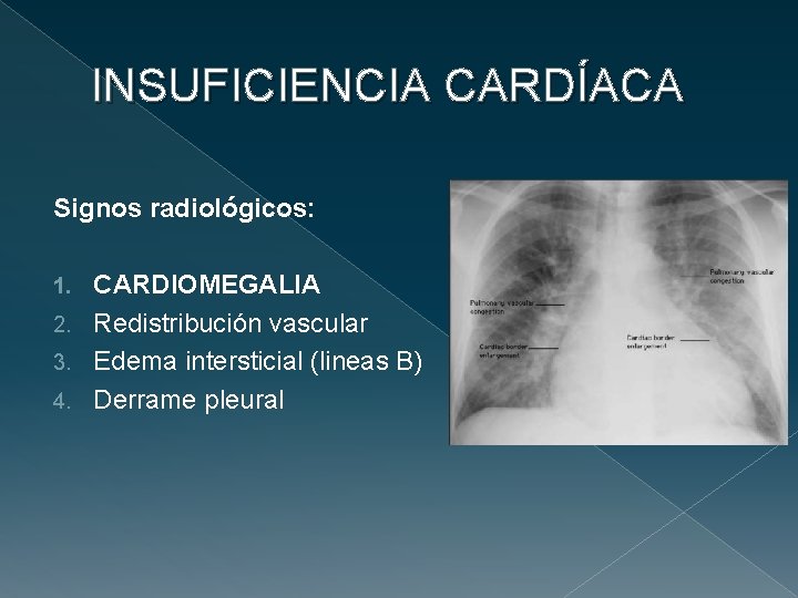INSUFICIENCIA CARDÍACA Signos radiológicos: CARDIOMEGALIA 2. Redistribución vascular 3. Edema intersticial (lineas B) 4.
