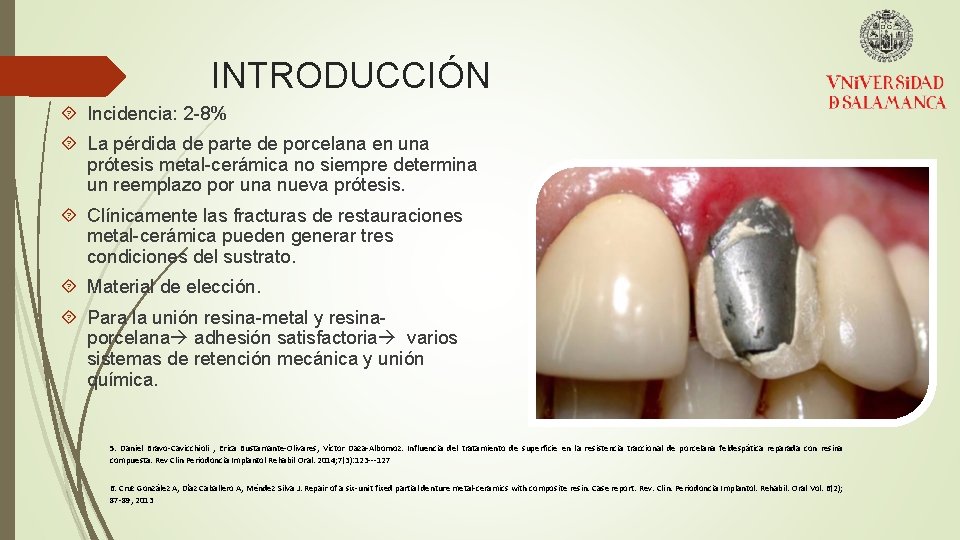 INTRODUCCIÓN Incidencia: 2 -8% La pérdida de parte de porcelana en una prótesis metal-cerámica