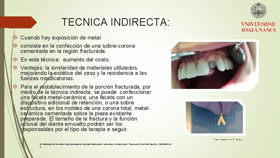 TECNICA INDIRECTA: Cuando hay exposición de metal consiste en la confección de una sobre-corona