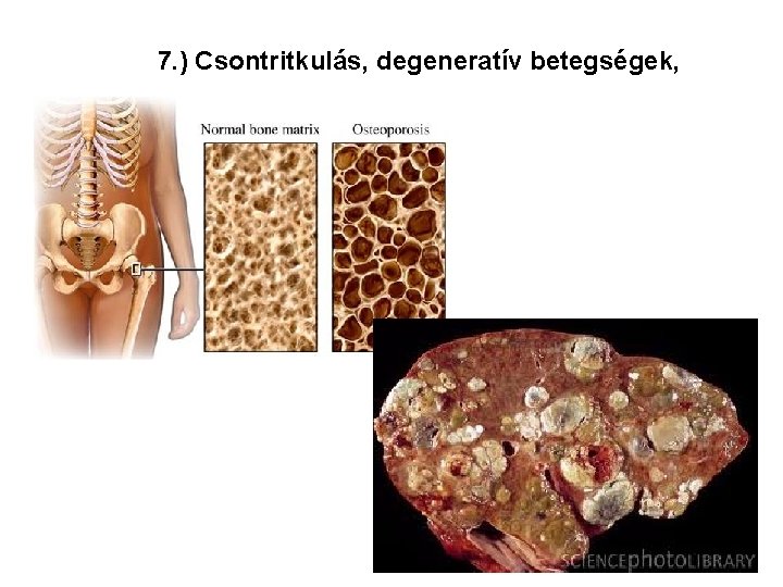7. ) Csontritkulás, degeneratív betegségek, 7. ) Csontritkulás, degeneratív betegségek,