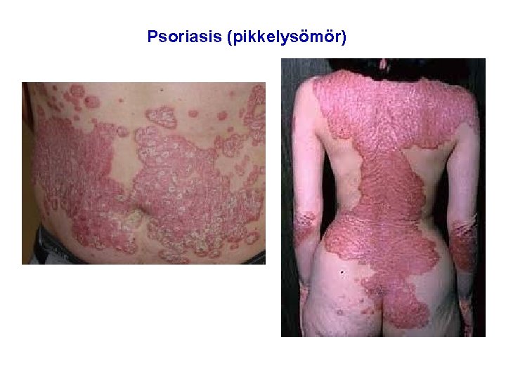 Psoriasis (pikkelysömör) 