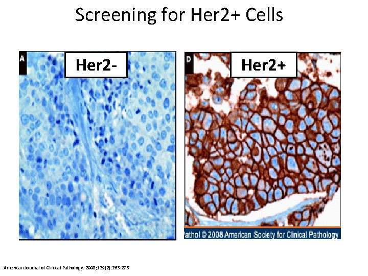 Screening for Her 2+ Cells Her 2 - American Journal of Clinical Pathology. 2008;