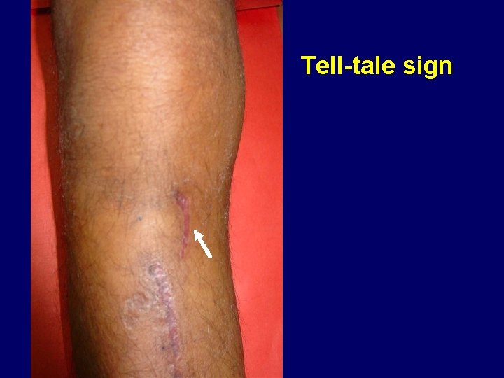 Tell-tale sign 