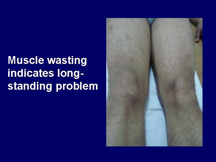 Muscle wasting indicates longstanding problem 