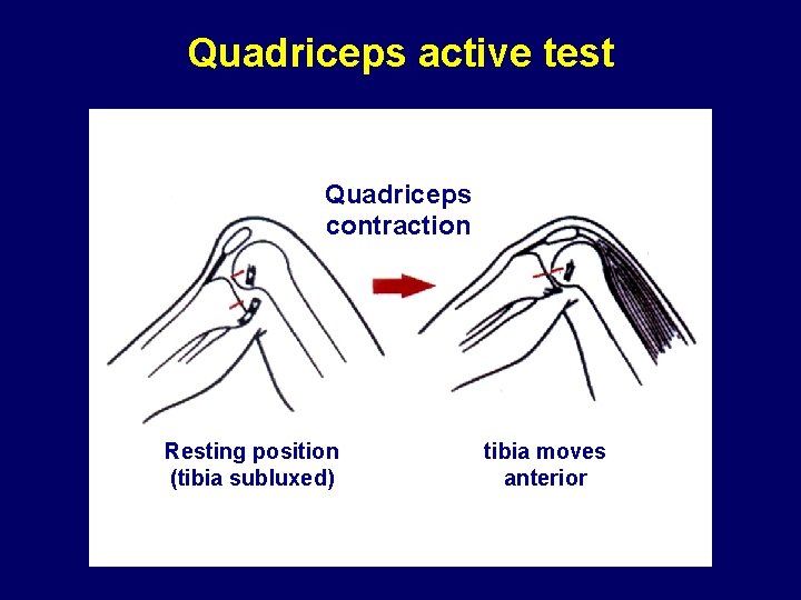 Quadriceps active test Quadriceps contraction Resting position (tibia subluxed) tibia moves anterior 