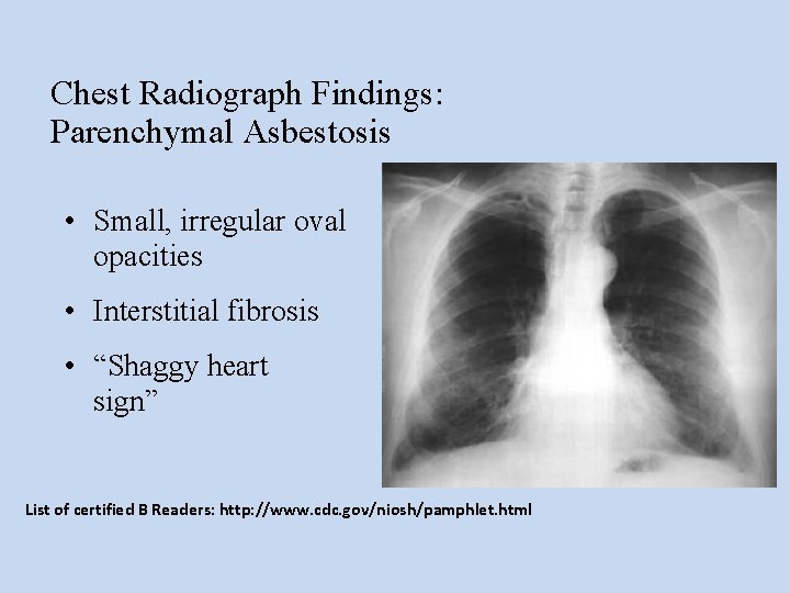 Chest Radiograph Findings: Parenchymal Asbestosis • Small, irregular oval opacities • Interstitial fibrosis •