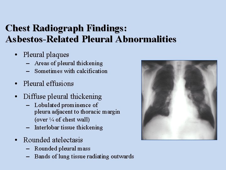 Chest Radiograph Findings: Asbestos-Related Pleural Abnormalities • Pleural plaques – Areas of pleural thickening