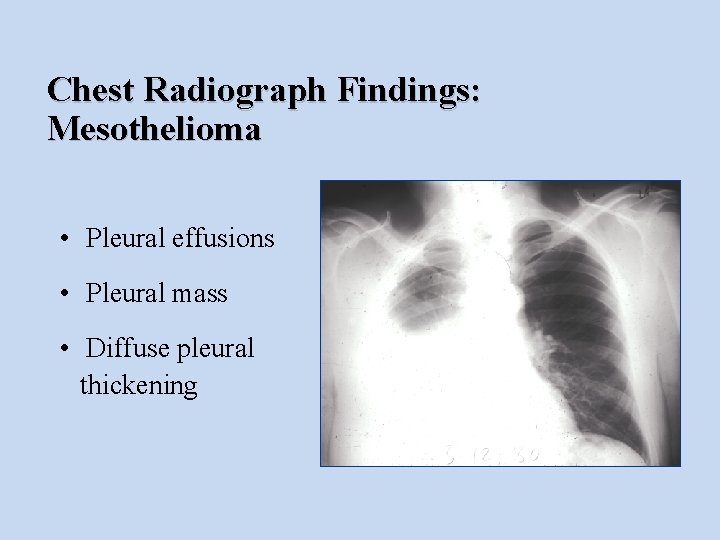 Chest Radiograph Findings: Mesothelioma • Pleural effusions • Pleural mass • Diffuse pleural thickening