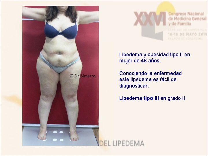 Lipedema y obesidad tipo II en mujer de 46 años. Conociendo la enfermedad este
