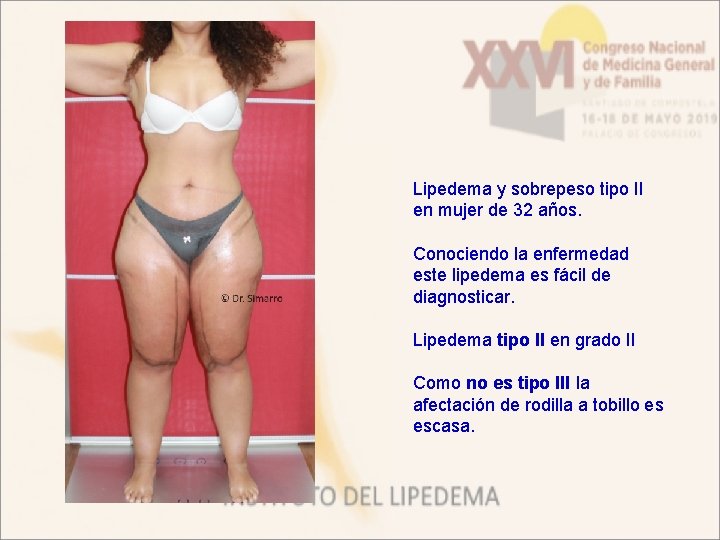 Lipedema y sobrepeso tipo II en mujer de 32 años. Conociendo la enfermedad este